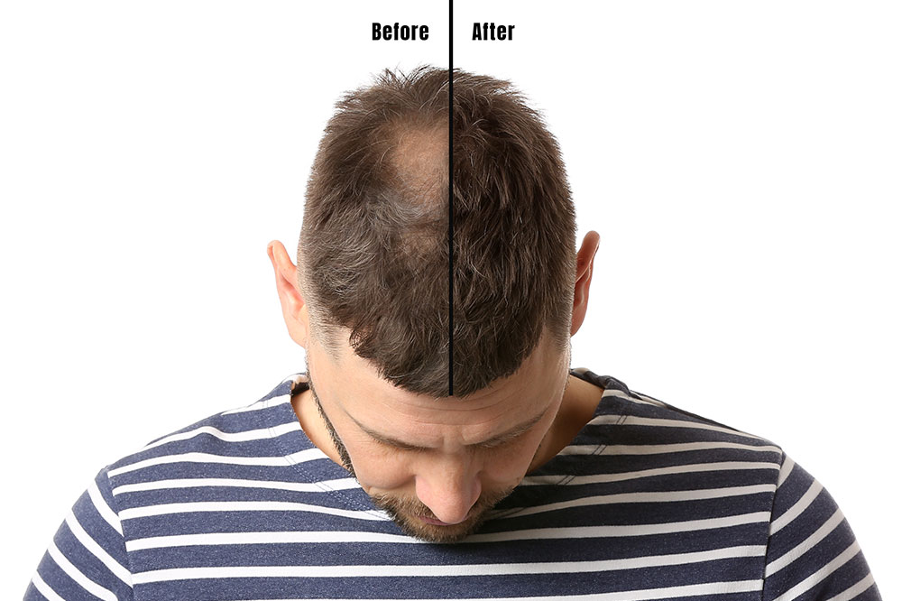 Know how laser caps help encourage hair growth