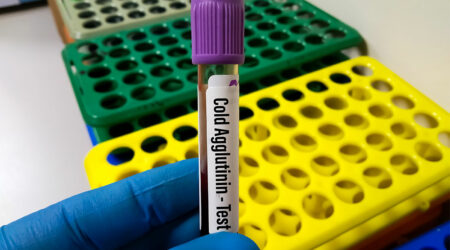 Cold Agglutinin Disease (CAD) – Causes, symptoms, and more