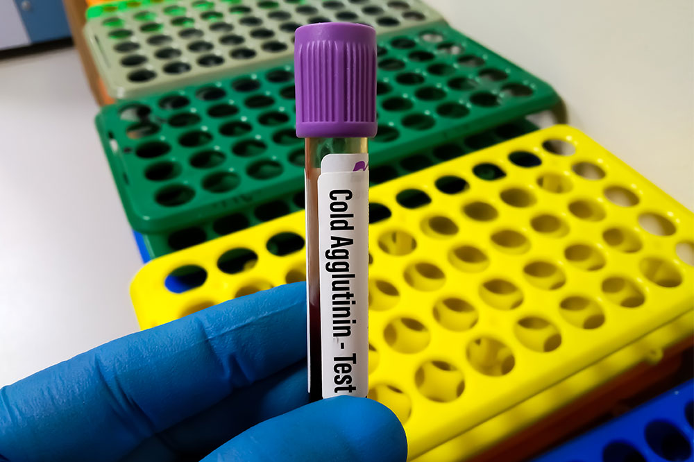 Cold Agglutinin Disease (CAD) – Causes, symptoms, and more